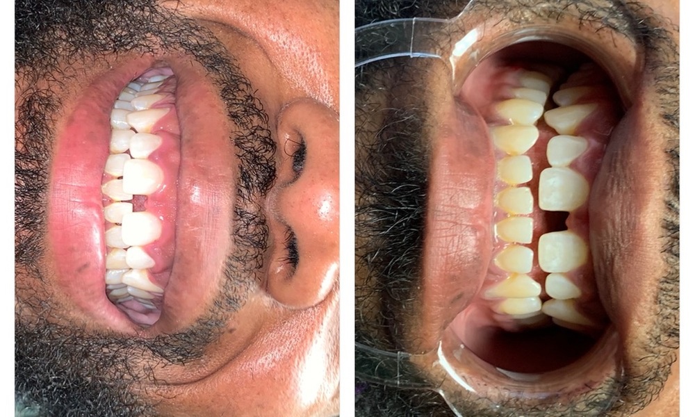 Brighten Your Smile with Teeth Whitening Options Available