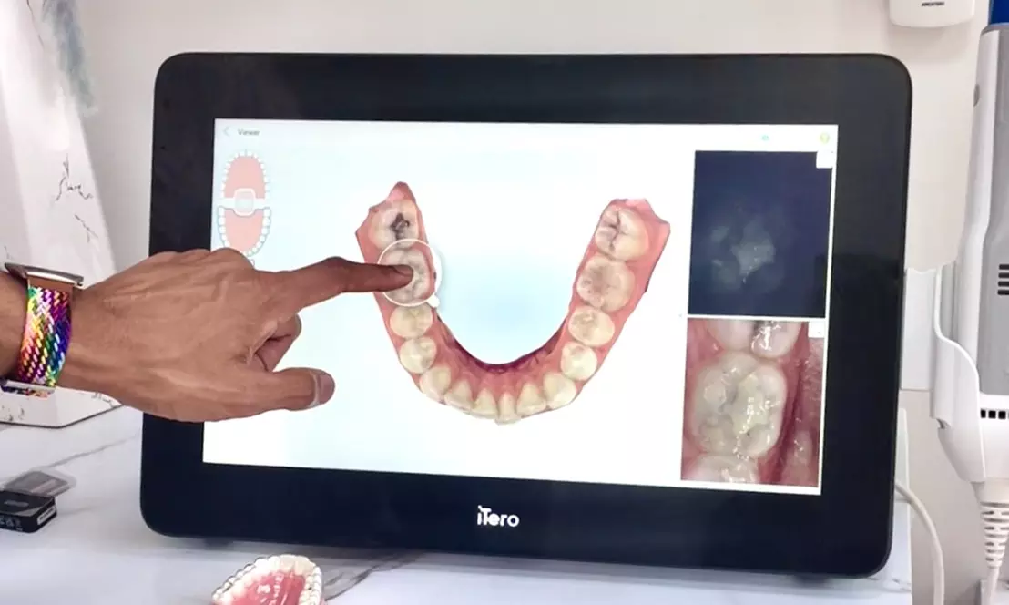Clear or Metal Braces on One or Both Arches