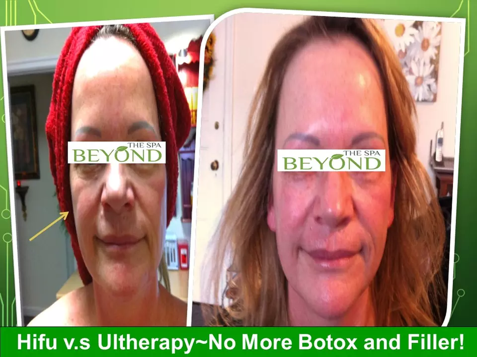 Lymphatic Drainage Massage with Hifu Options for Face and Body