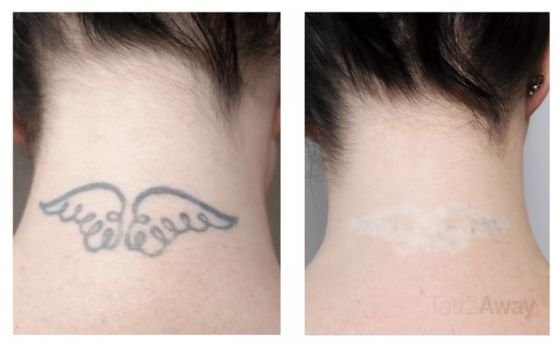 Up to 50% Off on choosing a tattoo removal session for any area at Alive Health and wellness - Primary Image