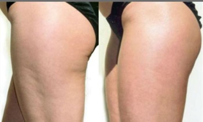 Experience Radio Frequency Skin Tightening Treatment
