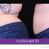 Image 7: Experience Non-Invasive Fat Reduction with TruSculpt