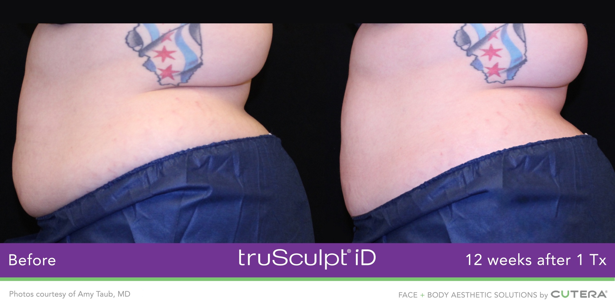Experience Non-Invasive Fat Reduction with TruSculpt