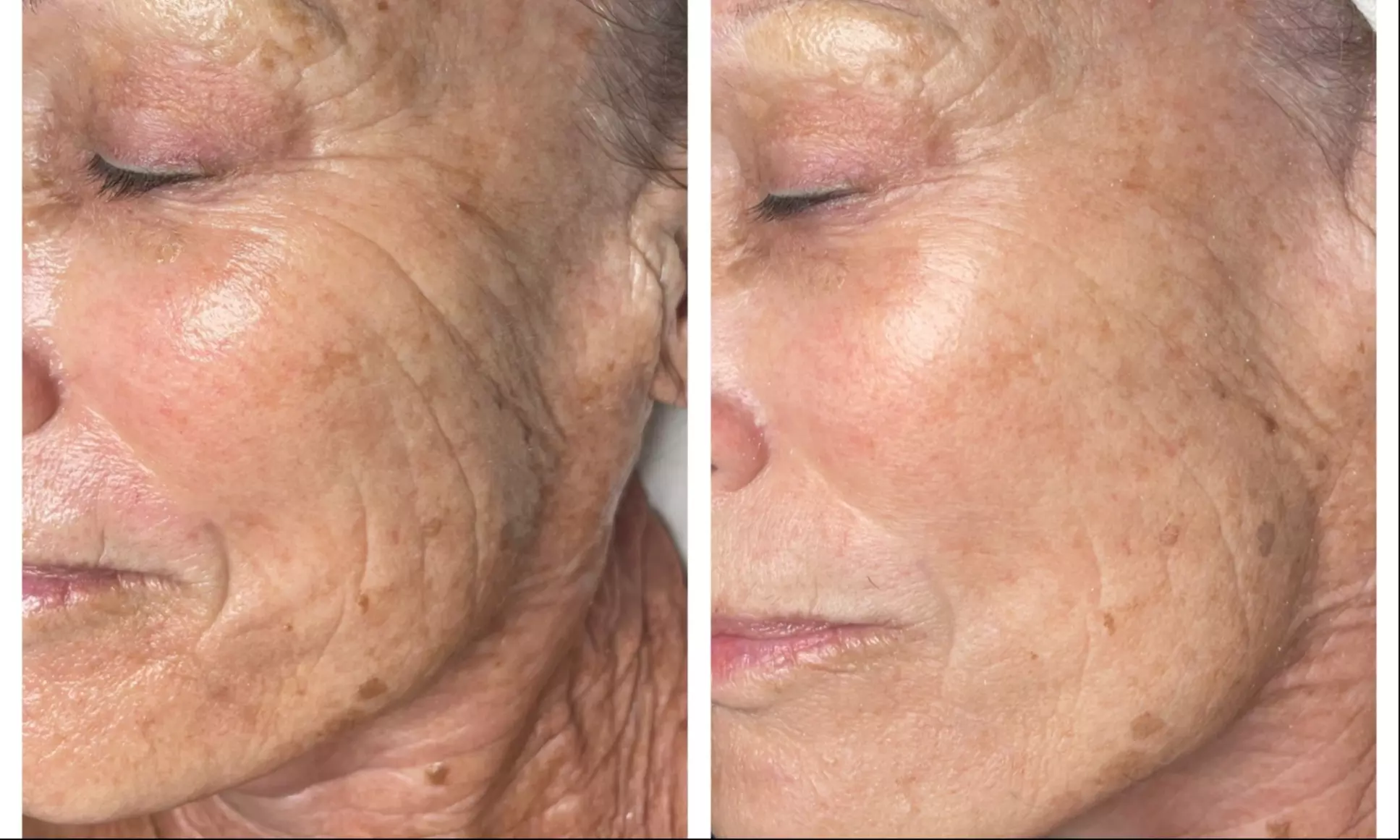 Revitalize Your Skin with Customized Facial and Peels