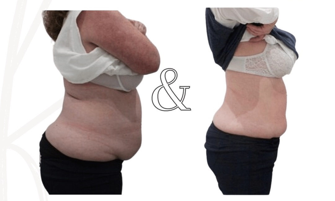 Fat / Cellulite Reduction - Non-Branded at Feluxe LTD
