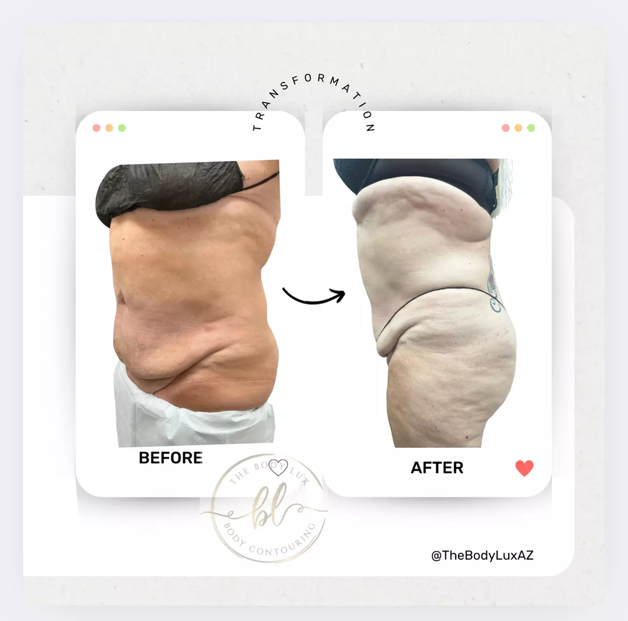 Up to 60% Off on Lipo - Non-Invasive Laser-iLipo at The Body Lux