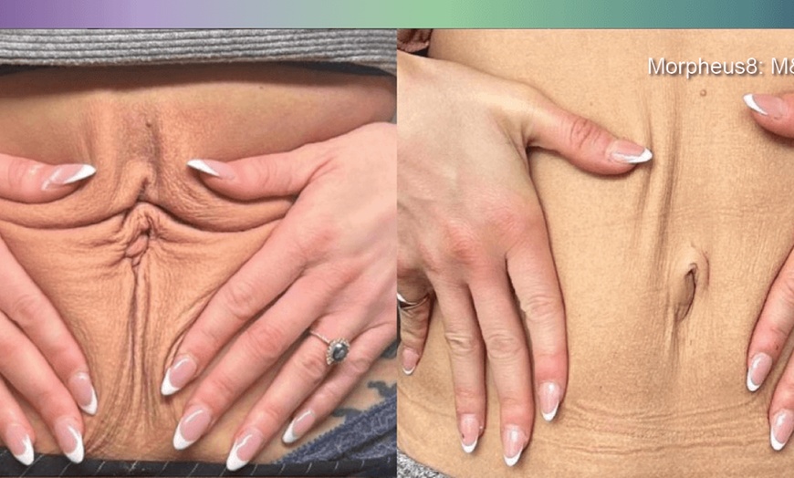 Image 7: Morpheus 8 Face and Neck / Abdomen or Butt Treatment at No Pain All Gain Spa (Up to 37% Off)