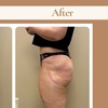 Image 2: Up to 45% Off on Non-Surgical Butt Lift at Double Take Body Studio