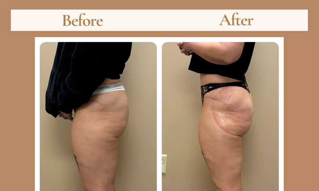 Up to 51% Off on Non-Surgical Butt Lift at Double Take Body Studio