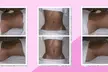 Up to 52% Off on Lipo - Non-Invasive Laser-iLipo at Shapes Lymphatic - Second Medium