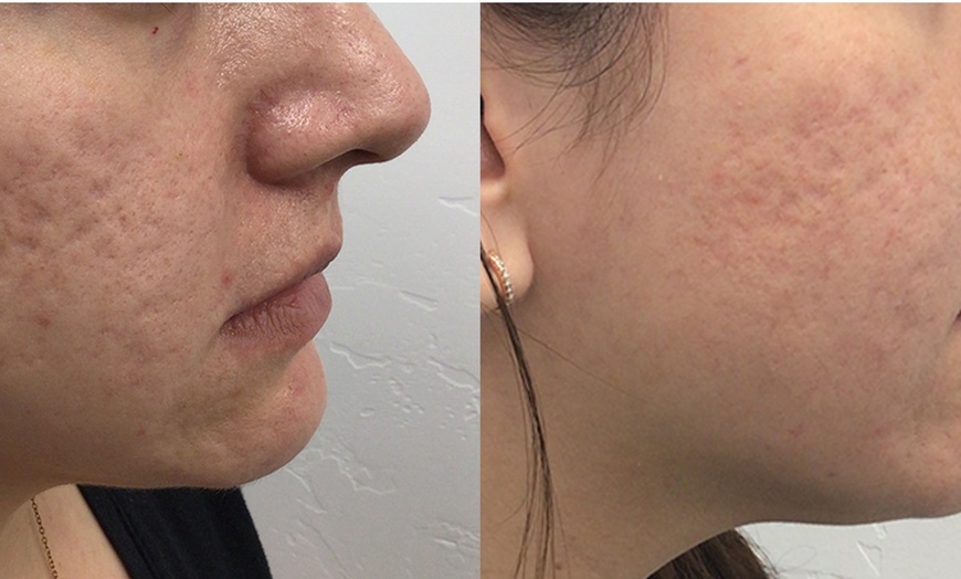 Image 4: Radiant Skin Awaits: Transform with Morpheus8 RF Technology!