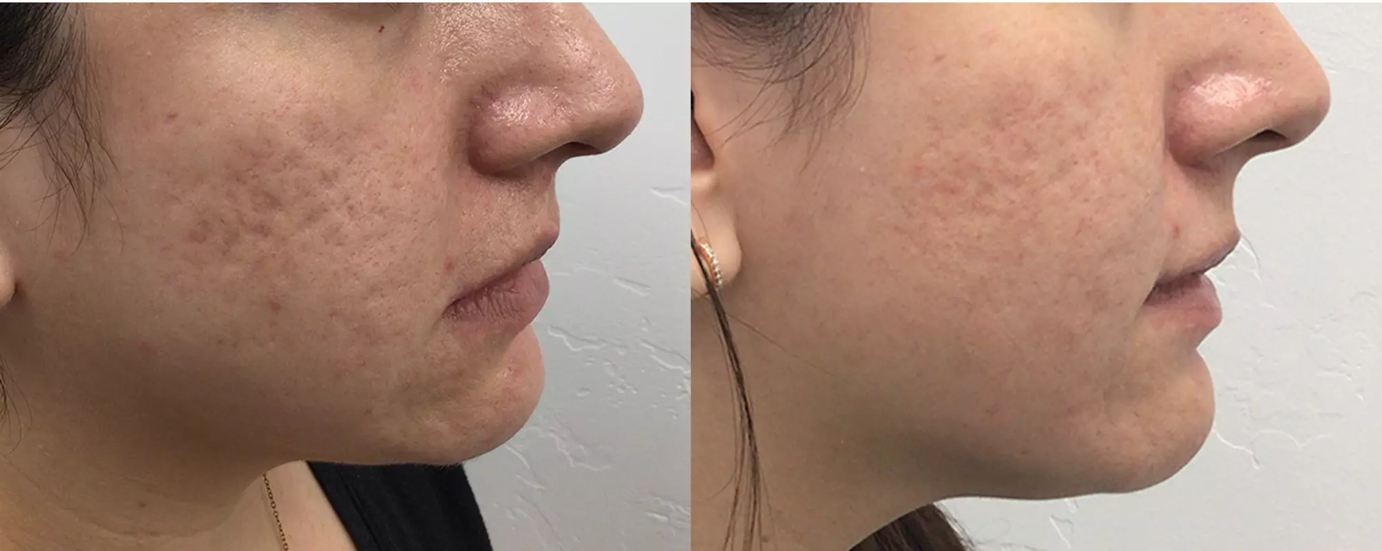 Up to 82% Off for Morpheus8 and Morpheus8 Body Radio-Frequency Skin Tightening at Victoria Med Spa - Second Medium