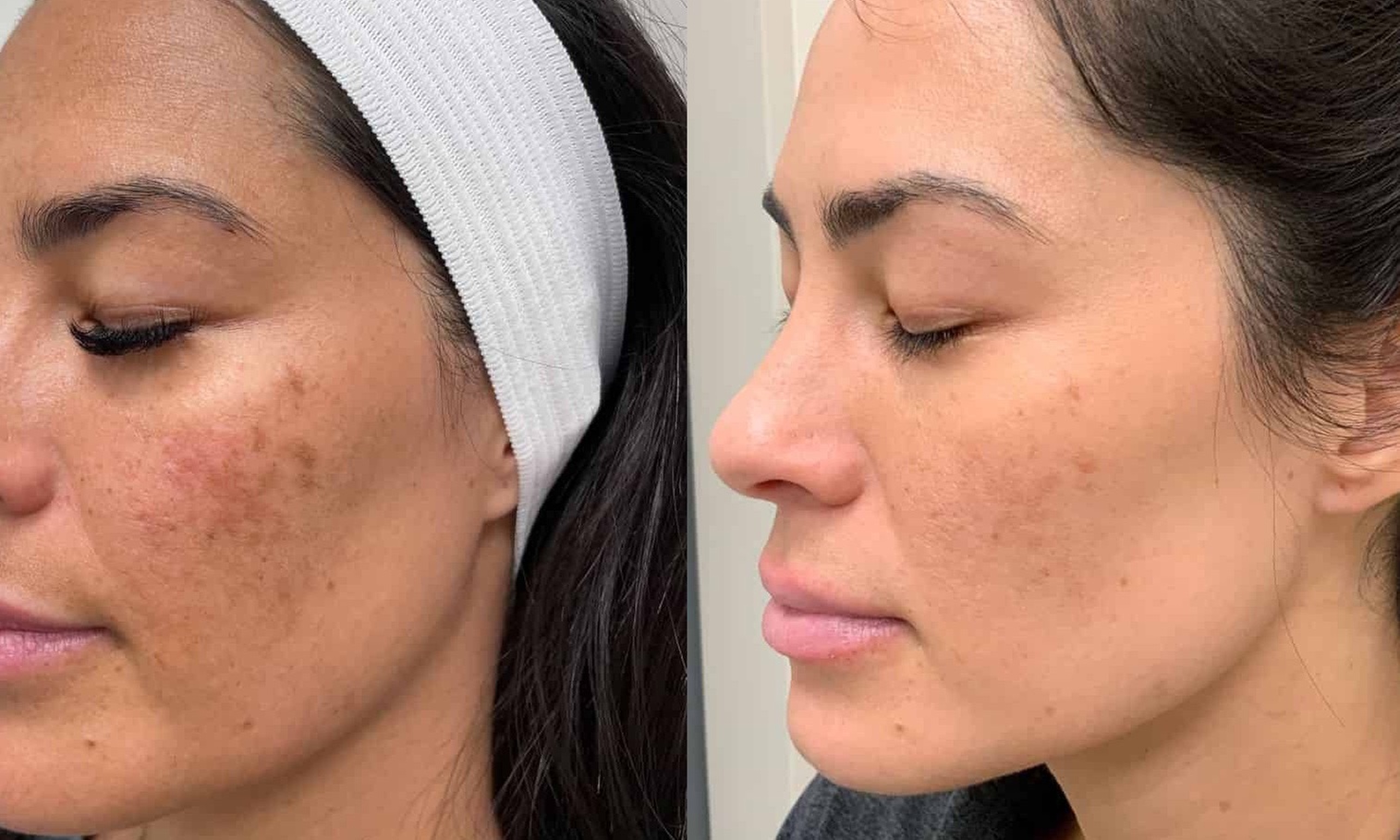 Up to 67% Off on Acne Treatment at Third Day Beauty