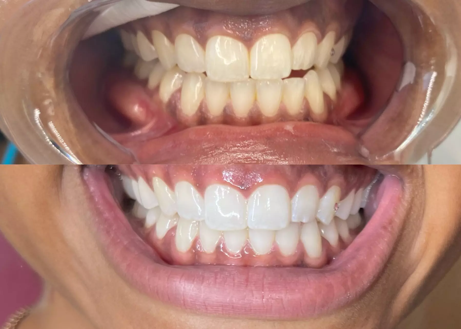 Experience a brighter smile with Million Dolla Smile by Miyalee's 30-minute teeth whitening treatment, up to 50% off - Primary Image