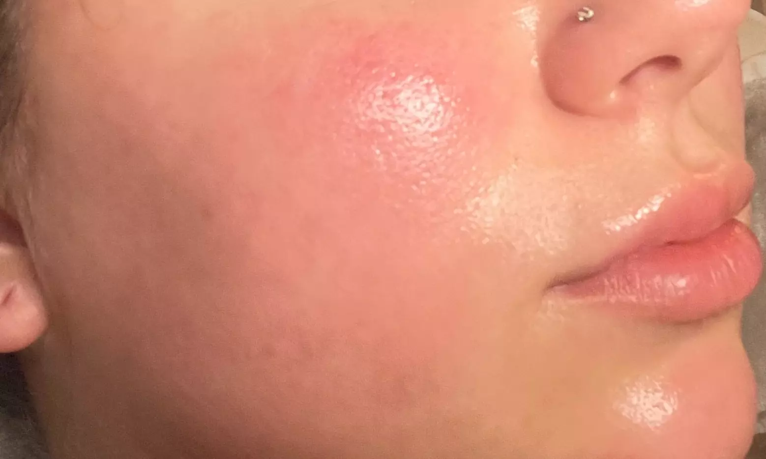 Up to 40% Off on HydraFacial at Shining Way Esthetics - Fort Lauderdale - Primary Image
