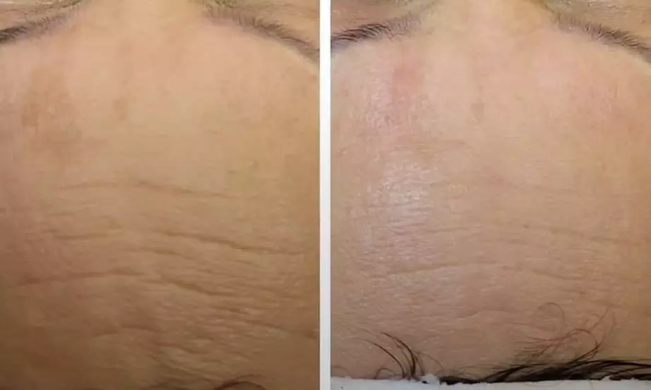 Try One or Three Radio Frequency Skin Tightening Treatments Today