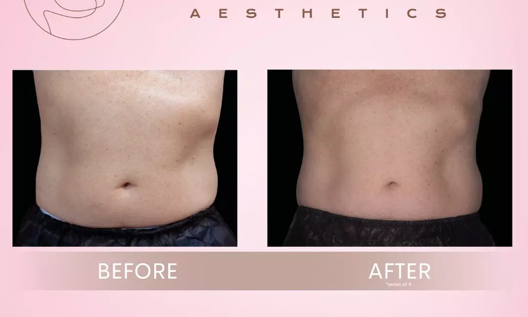Up to 30% Off on Fat Reduction - Non-Branded at Total Body Aesthetics - Second Medium