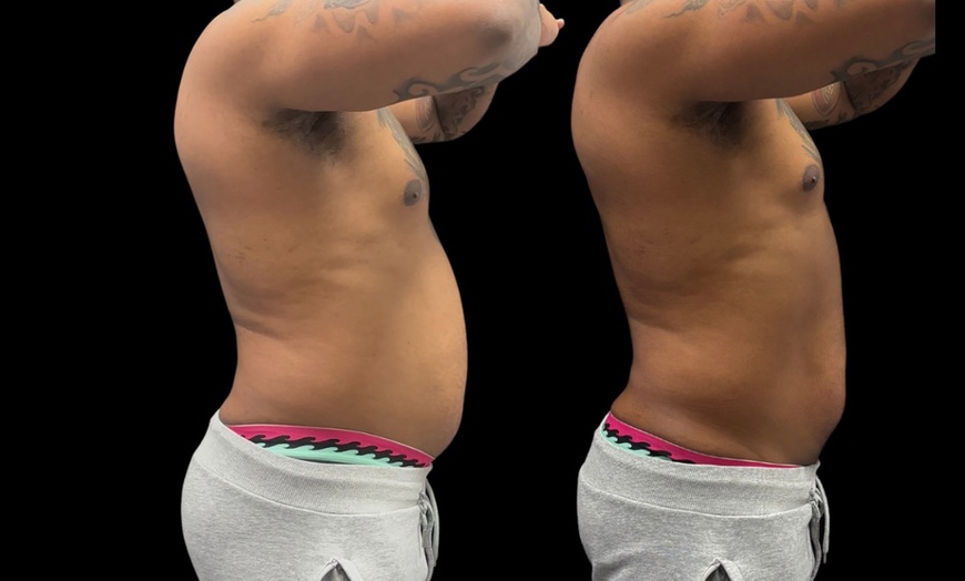 Image 2: Up to 55% Off on Ultrasonic Fat Reduction at Southern Shapez