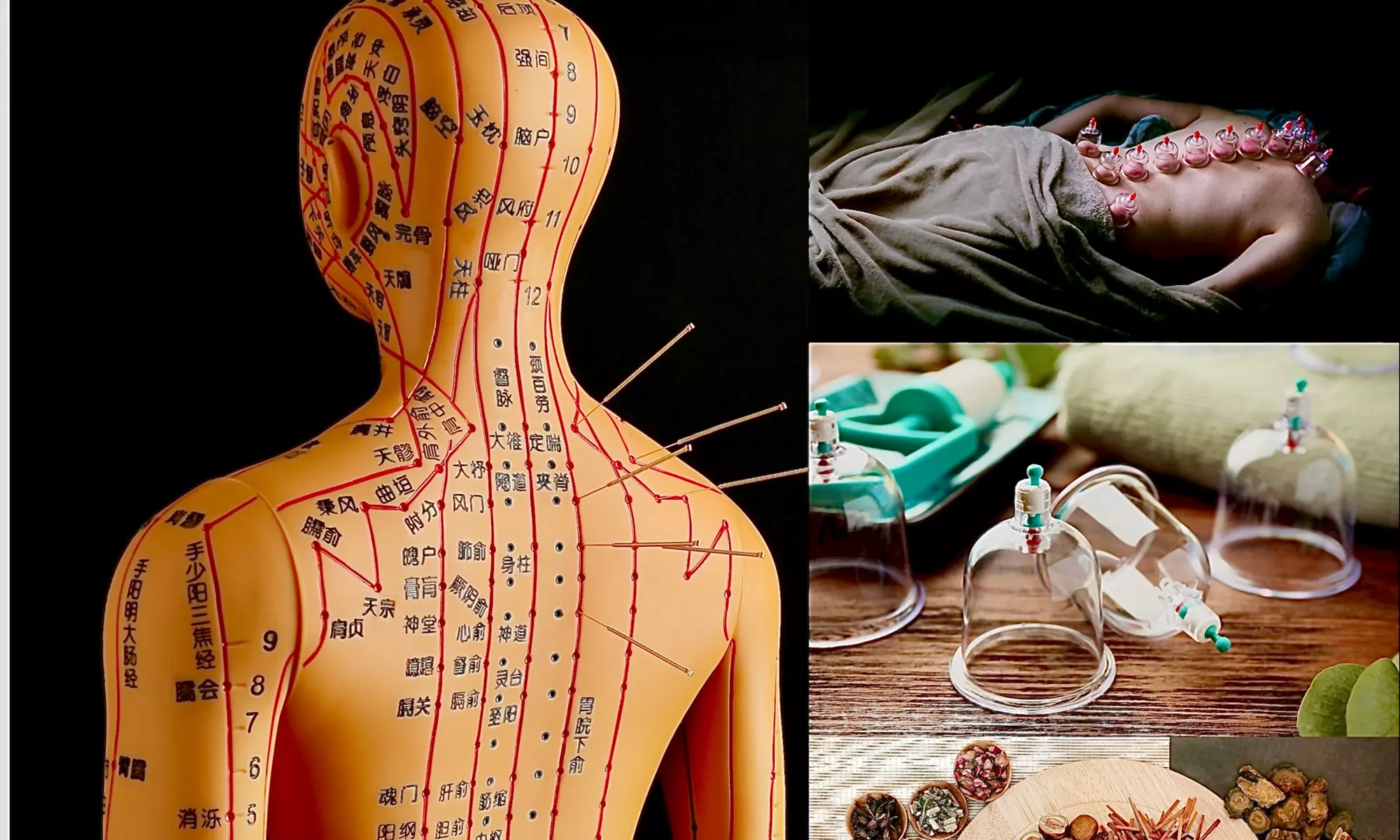 Up to 62% Off on Acupuncture