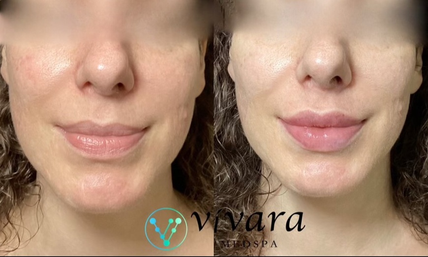 Image 1: 1 Syringe of Juvederm Ultra XC, Vollure, Voluma, Volux or Volbella at Vivara Med Spa(Up to 44% Off)