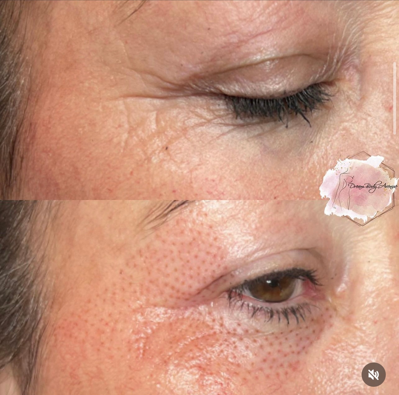 Up to 45% Off on Facelift - Non-Surgical at Dream Body Avenue