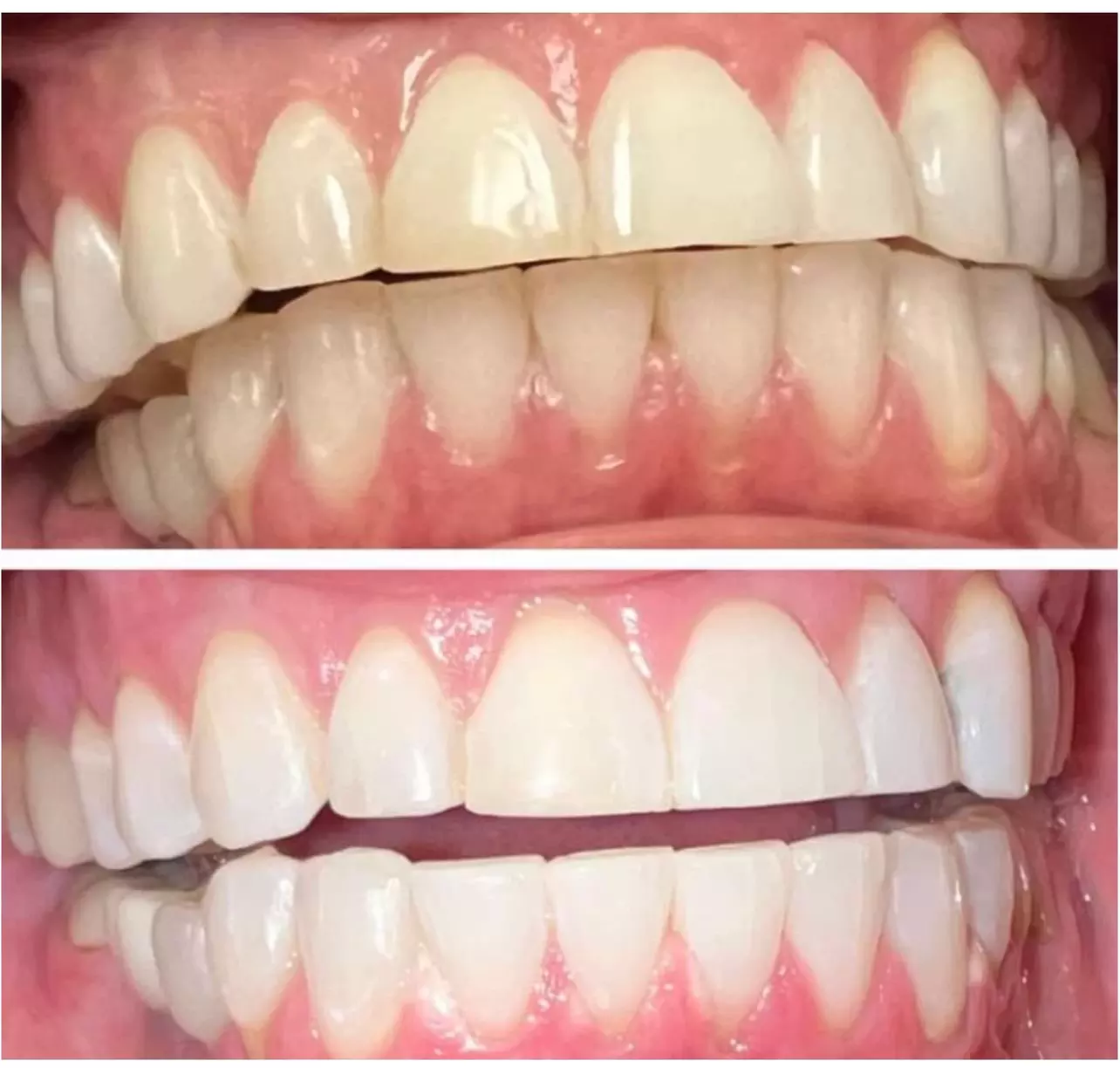 Up to 10% Off on Teeth Whitening - In-Office - Non-Branded at Changes Beaute Lounge - Second Medium