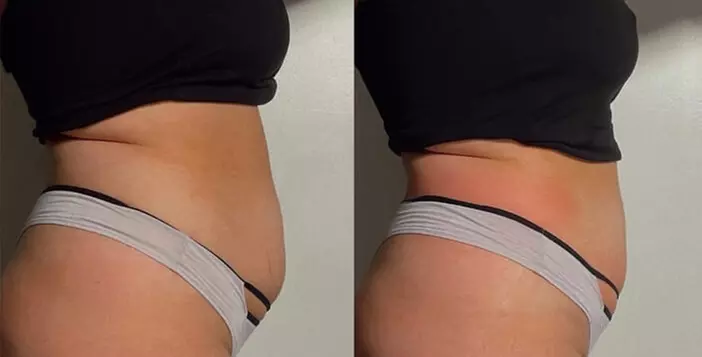 Explore Multiple Stomach Lipo Cavitation Sessions Options