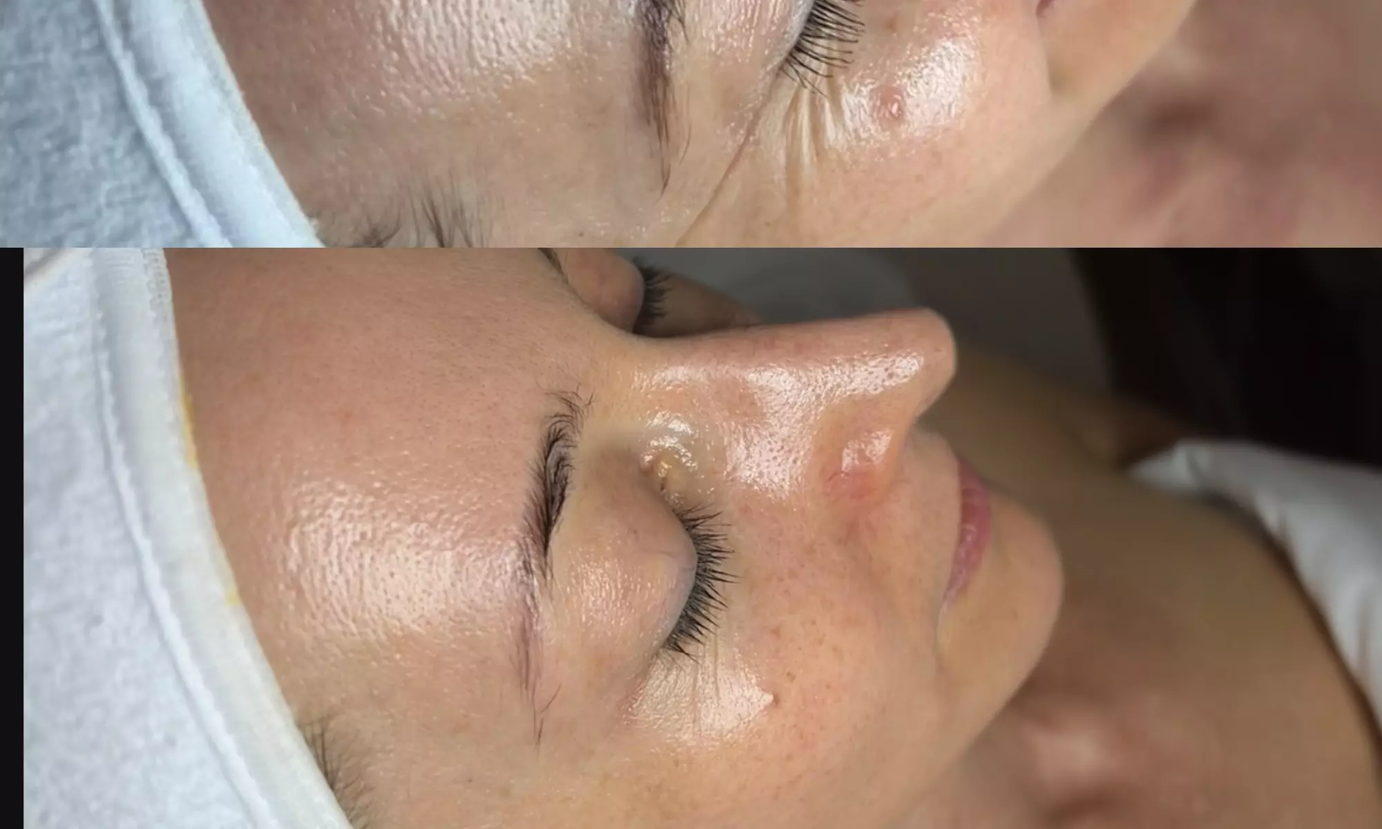 Up to 43% Off on Microdermabrasion at Whole skincare - Second Medium