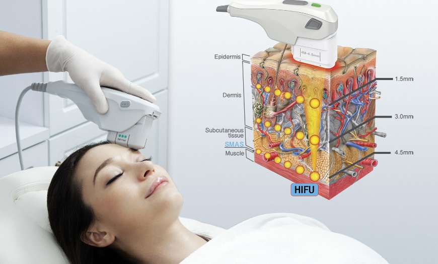 Image 1: Lift & Define: One Mid or Lower Face HIFU Face Lift