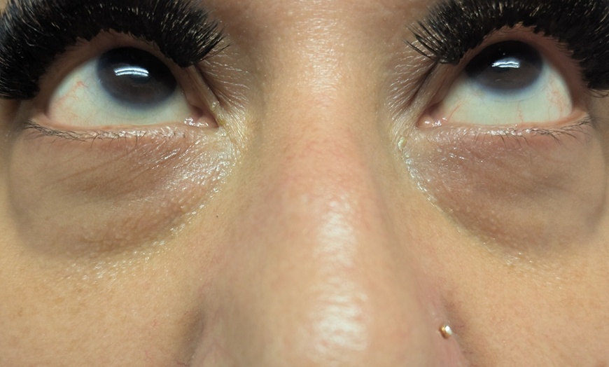 Image 3: Target Dark Circles & Puffiness: PRF Under-Eye Therapy (1/ 3 Sessions)