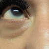 Image 3: Target Dark Circles & Puffiness: PRF Under-Eye Therapy (1/ 3 Sessions)