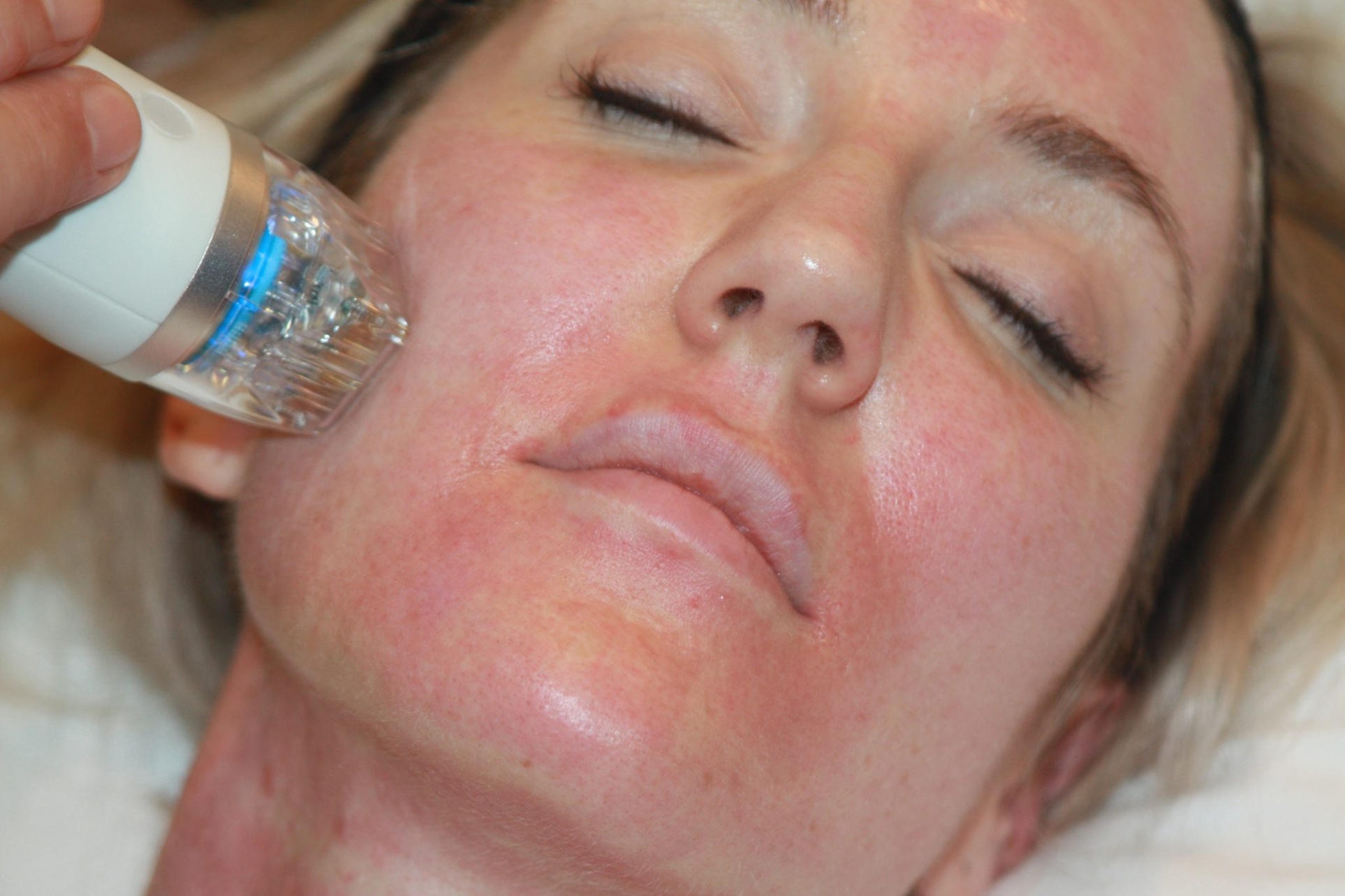 Radiant Skin: 60-Minute RF Microneedling for Face & Neck