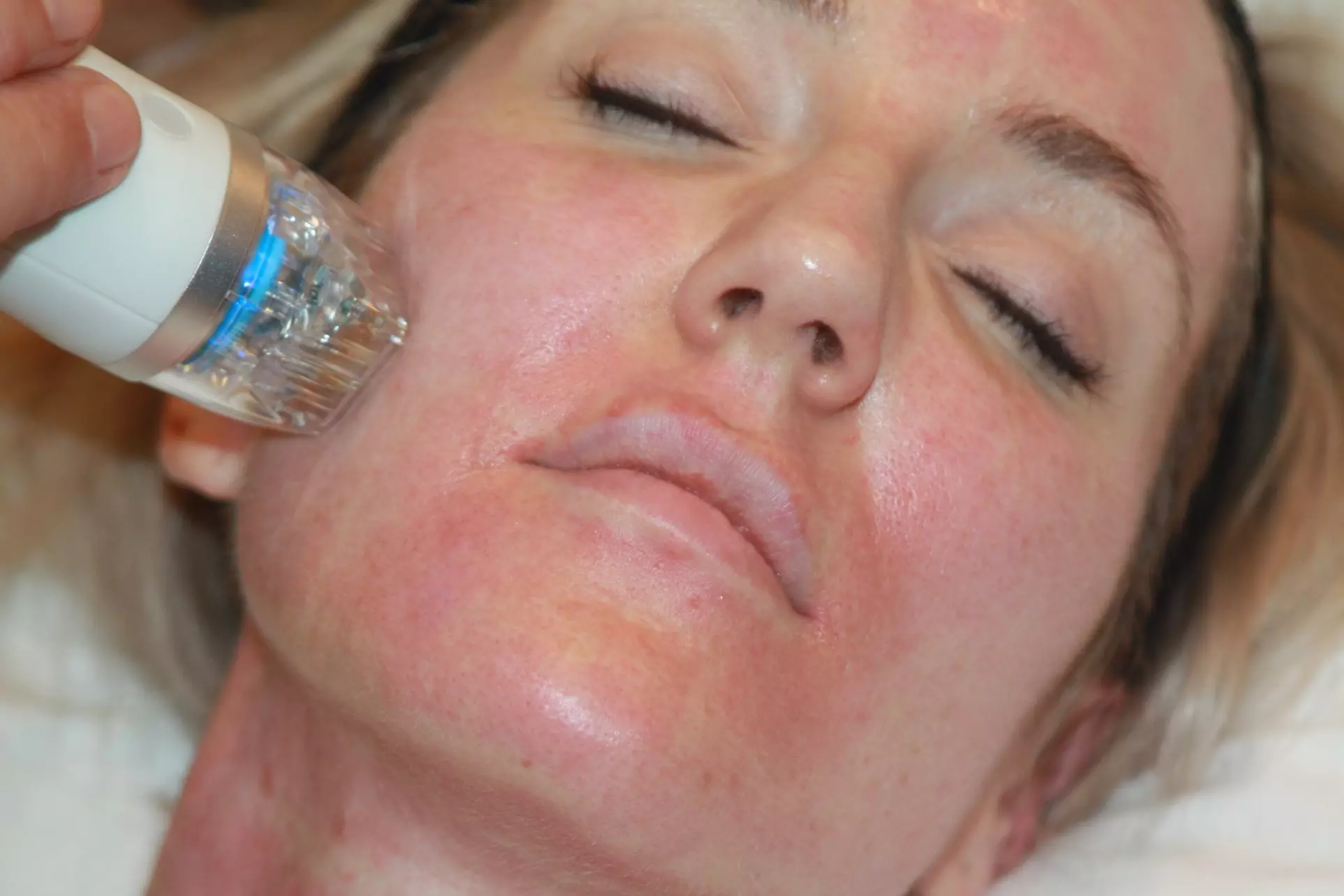 Enhance your beauty at BeautyNLight with RF microneedling for face and neck, offering rejuvenation up to 60% off - Primary Image