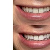 Image 2: Up to 30% Off on Teeth Whitening at Glow Beaute