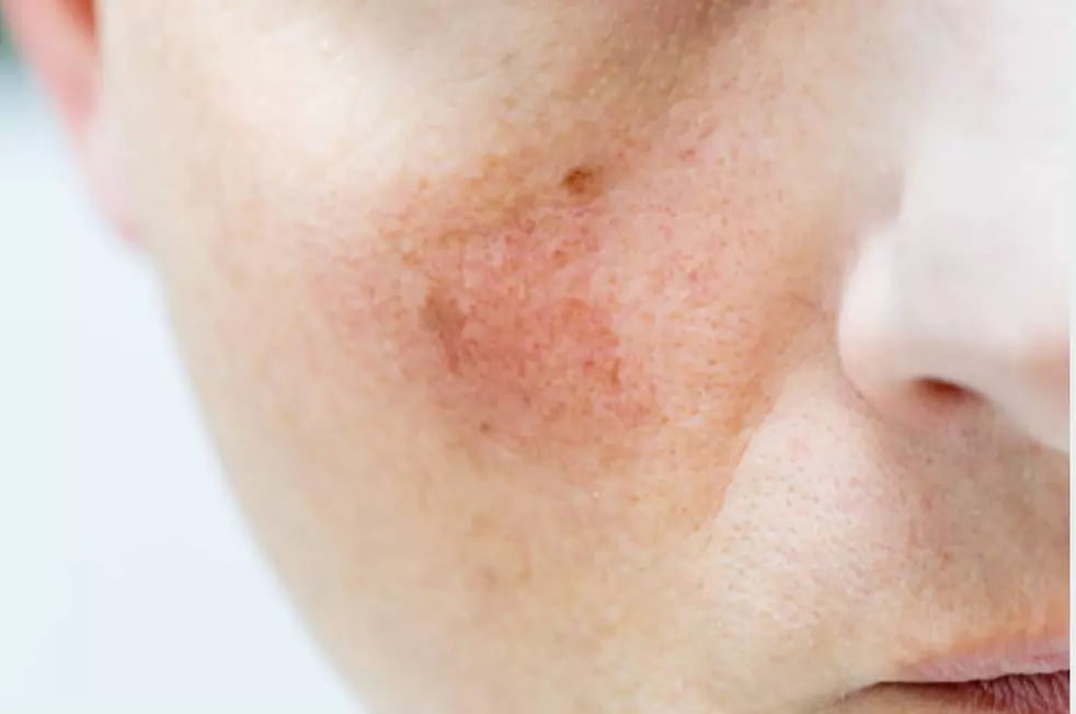 Experience facial capillaries removal at Lasers Medical Aesthetic Center, offering one treatment with up to 34% off - Primary Image