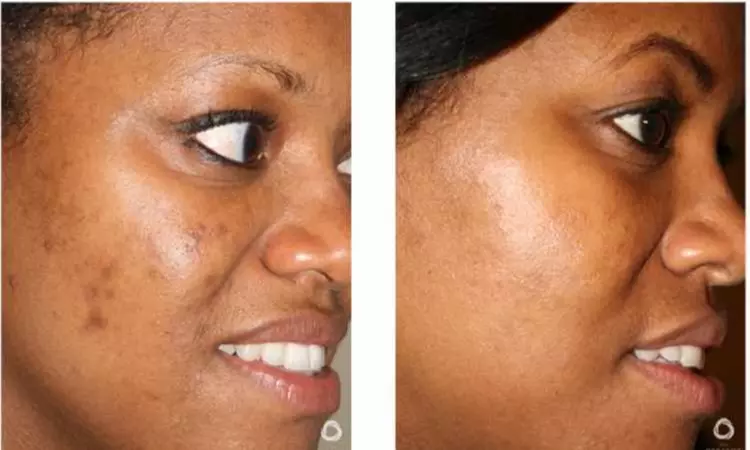 Up to 66% Off on Facial - Chemical Peel at UK Aesthetics Lounge