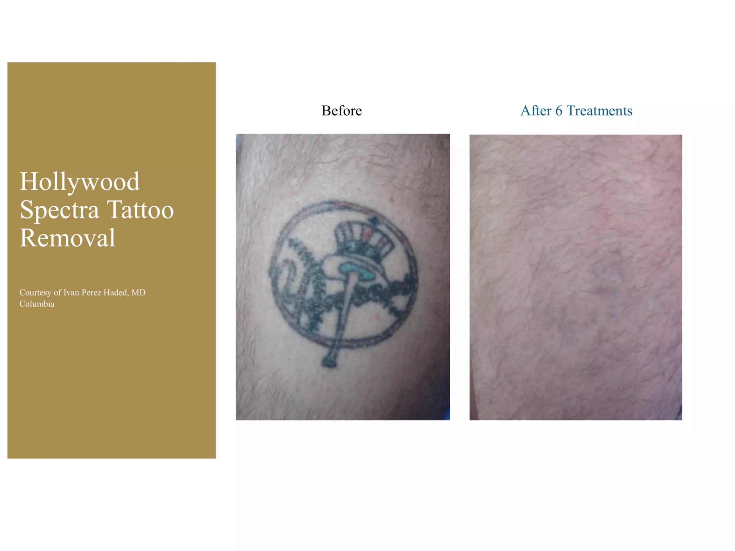 Up to 60% Off on Tattoo - Temporary at Surry Hills Laser & Cosmetic