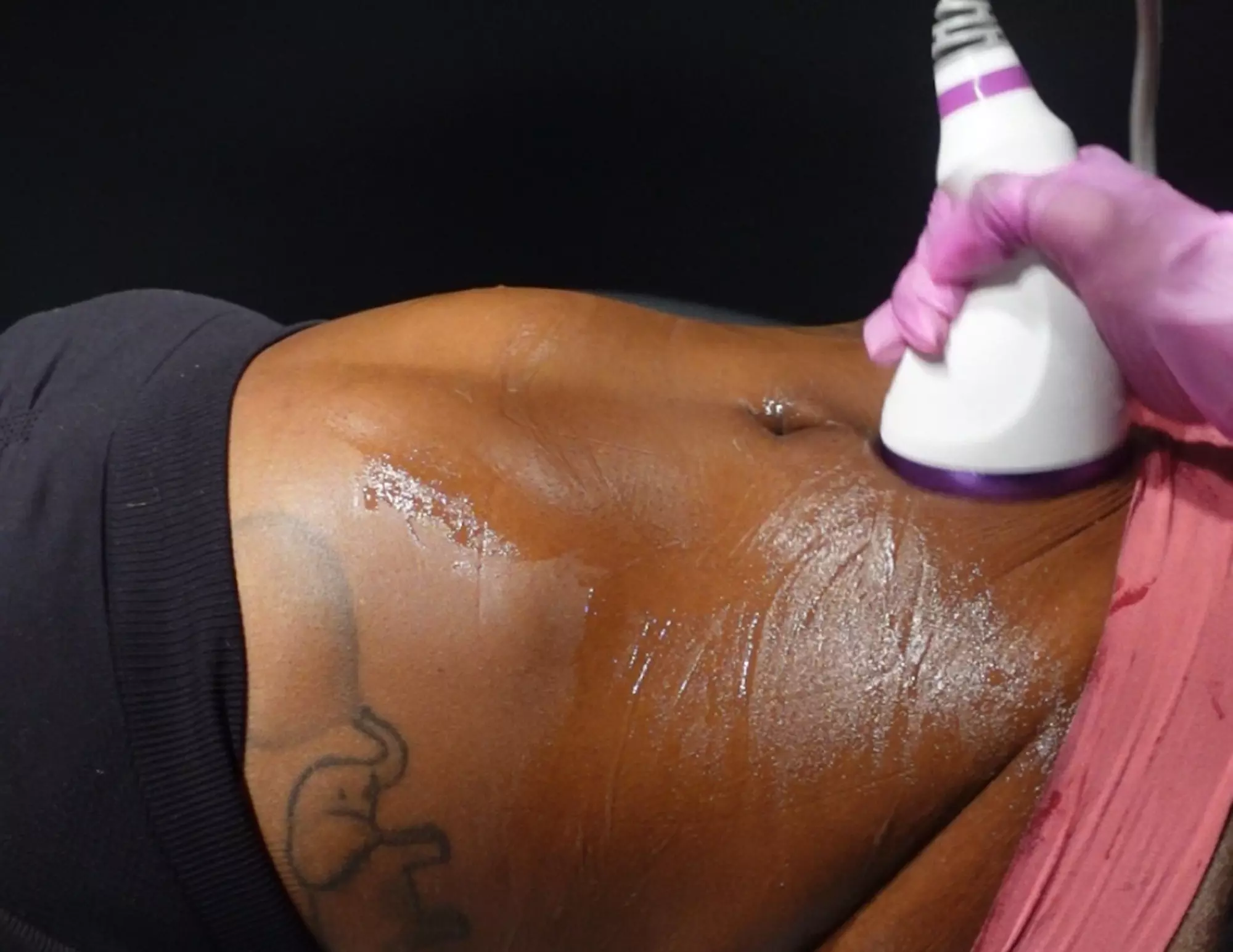 Sculpt Your Body: Laser Lipo Body Sculpting Service
