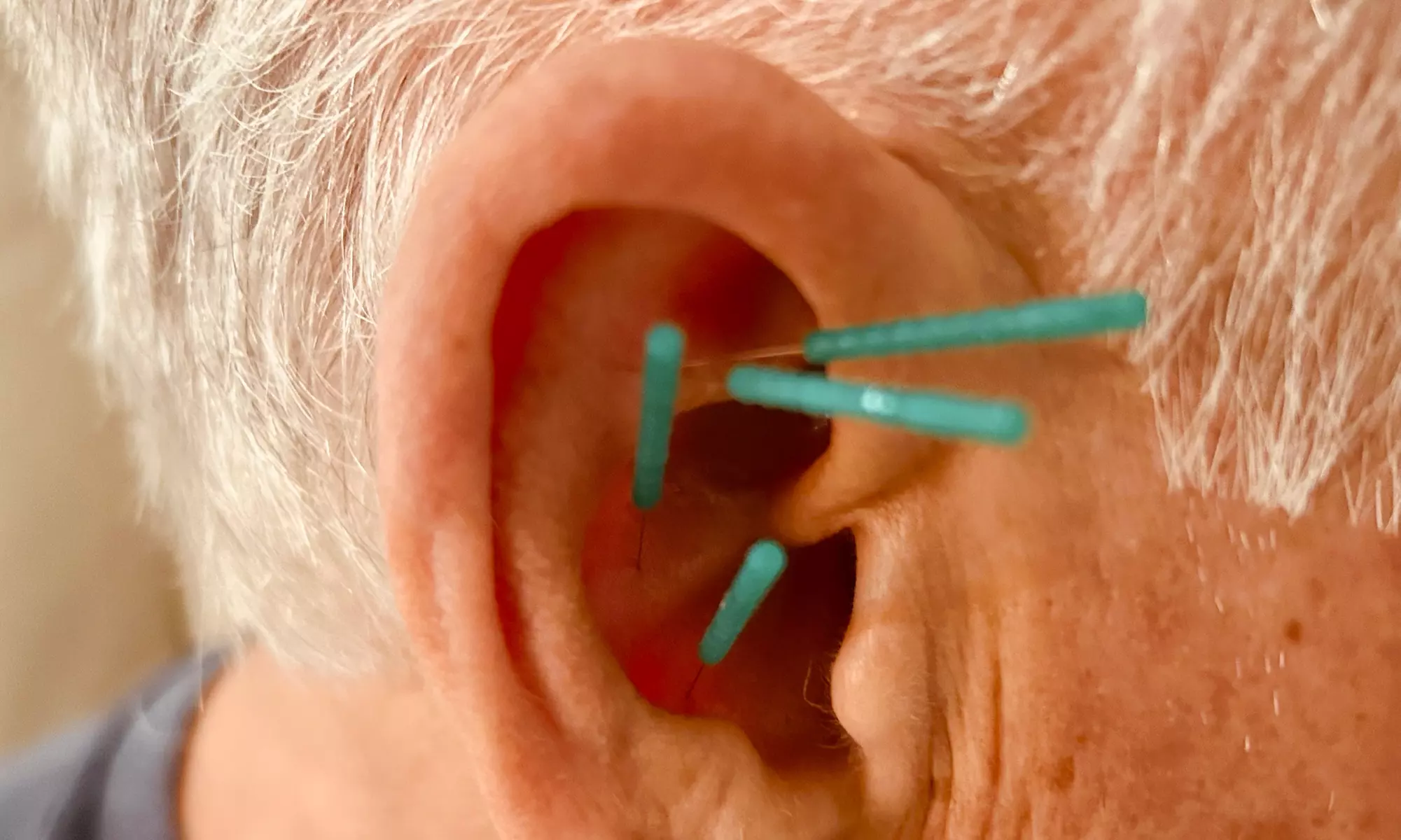 Discover Absolute Wellness Spa's ear acupuncture options with Swarovski crystals, silver, and gold pellets, saving up to 56% - Primary Image