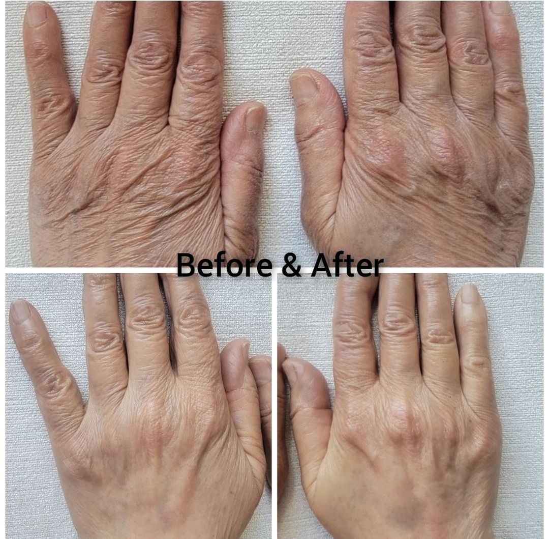 Up to 30% Off on Hand Rejuvenation at Dermapure, LLC