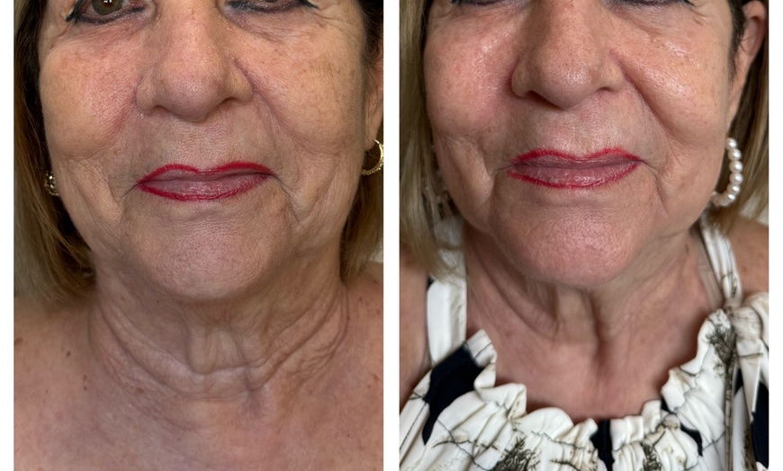 Image 10: Up to 55% Off on Laser Skin Resurfacing at Amora Med Spa