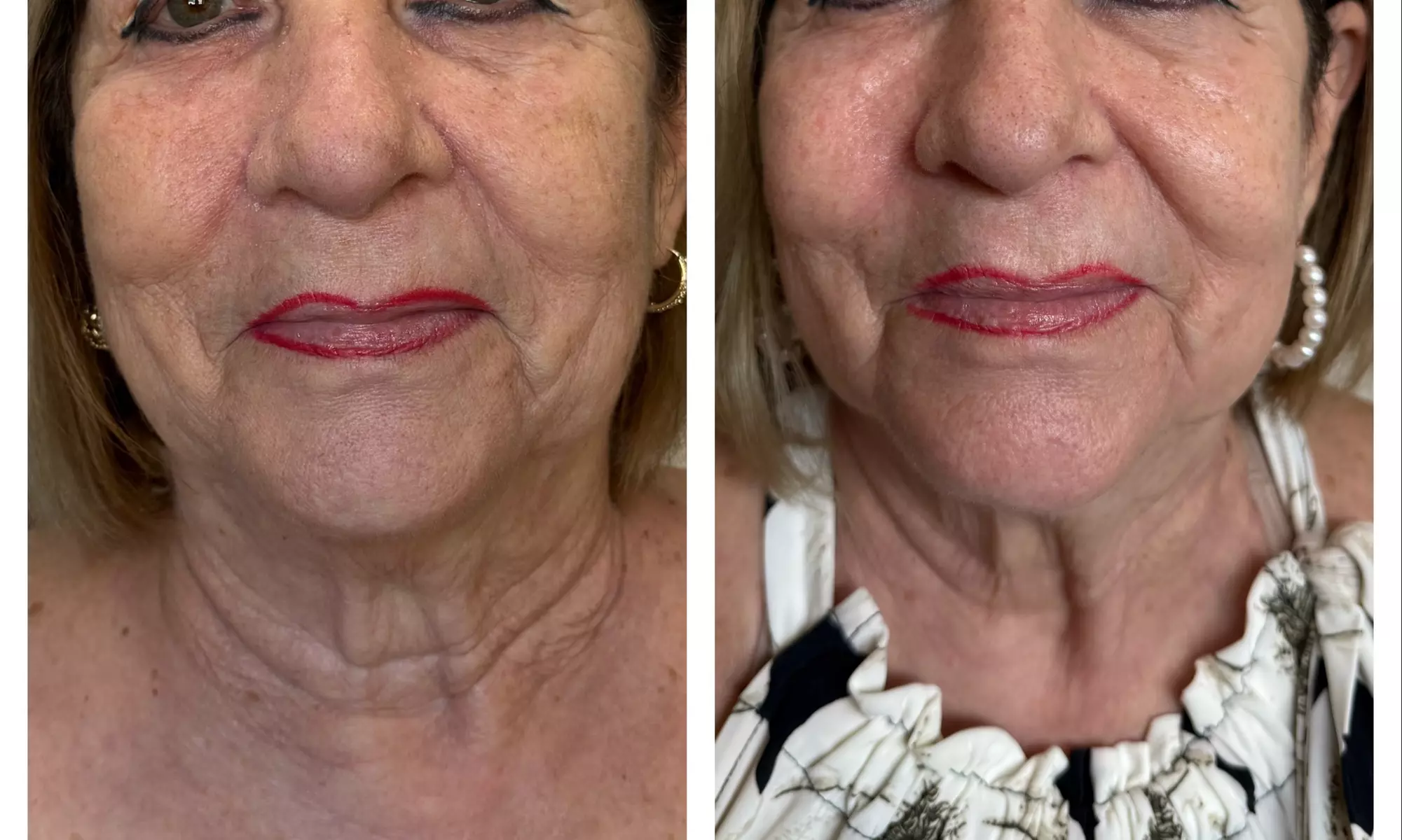 Up to 55% Off on Laser Skin Resurfacing at Amora Med Spa