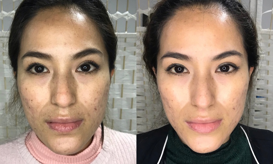 Image 2: Revitalize with 1 or 3 Non-Surgical Facelift and Anti-Aging Treatment