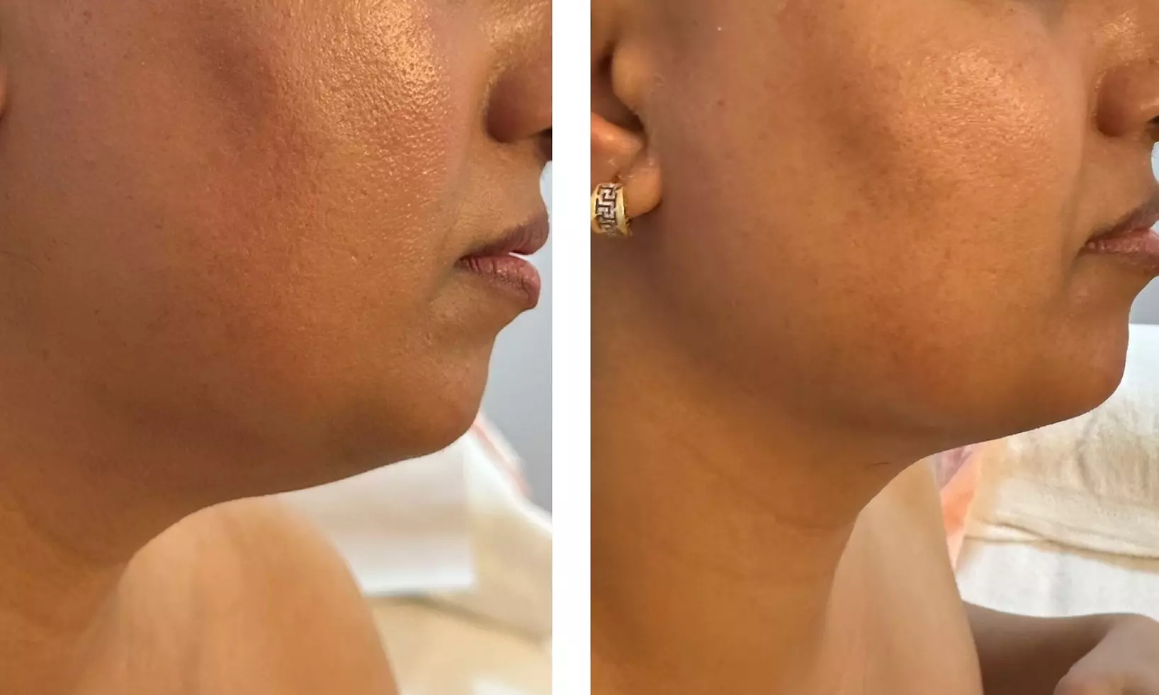 Up to 65% Off on Facelift - Non-Surgical at Velvet Vanity By Puja