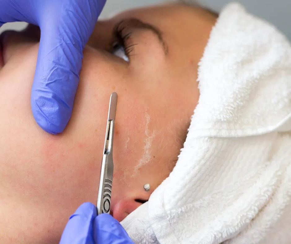 Facial Peeling Options: Choose from Dermaplaning Treatments