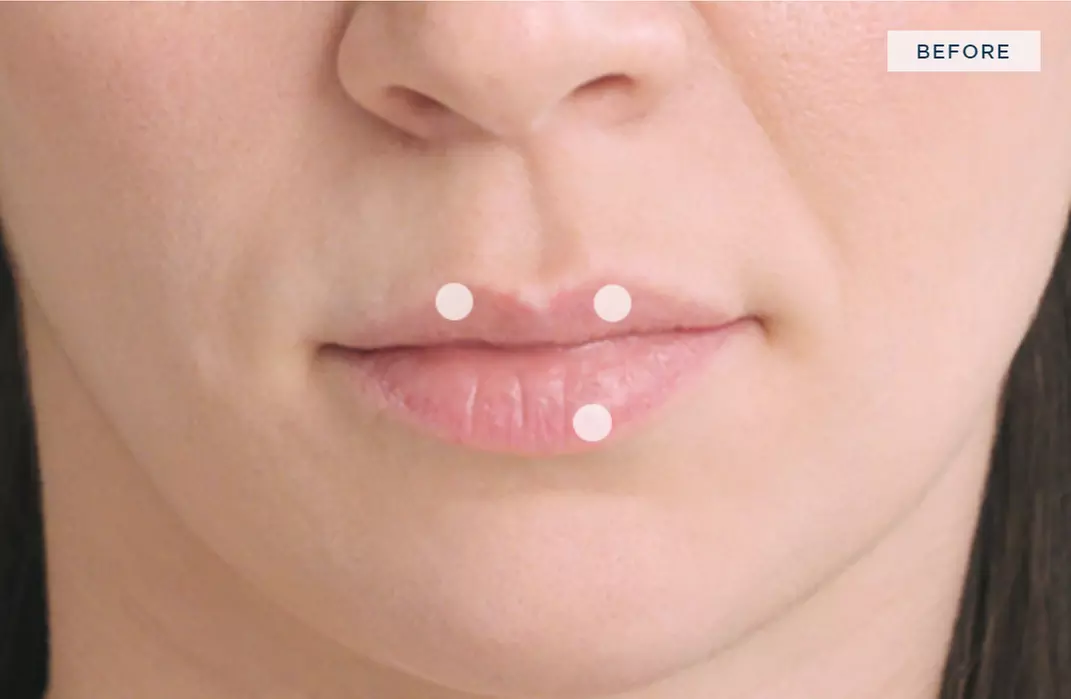 Up to 35% Off on Injection - Dermal Filler at MediMorph