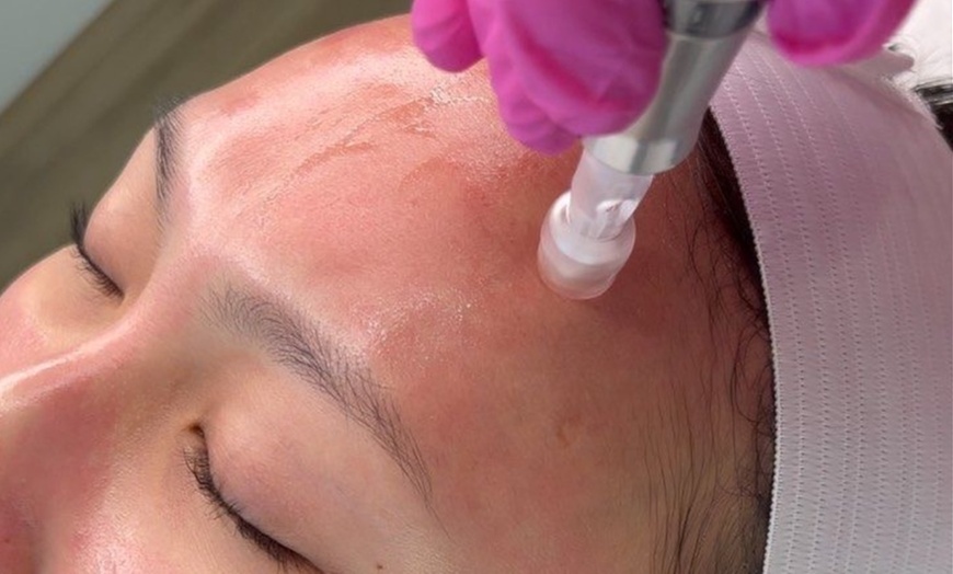 Image 1: Up to 43% Off on Micro-Needling at Zhané Enhanced