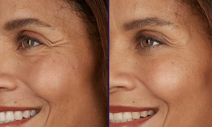 Smooth Away Fine Lines with 20 Units of Xeomin