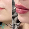 Image 1: Enhance your look with Vivara Med Spa's Revanesse Lip Filler and Versa+ Injections up to 33% off for a radiant appearance