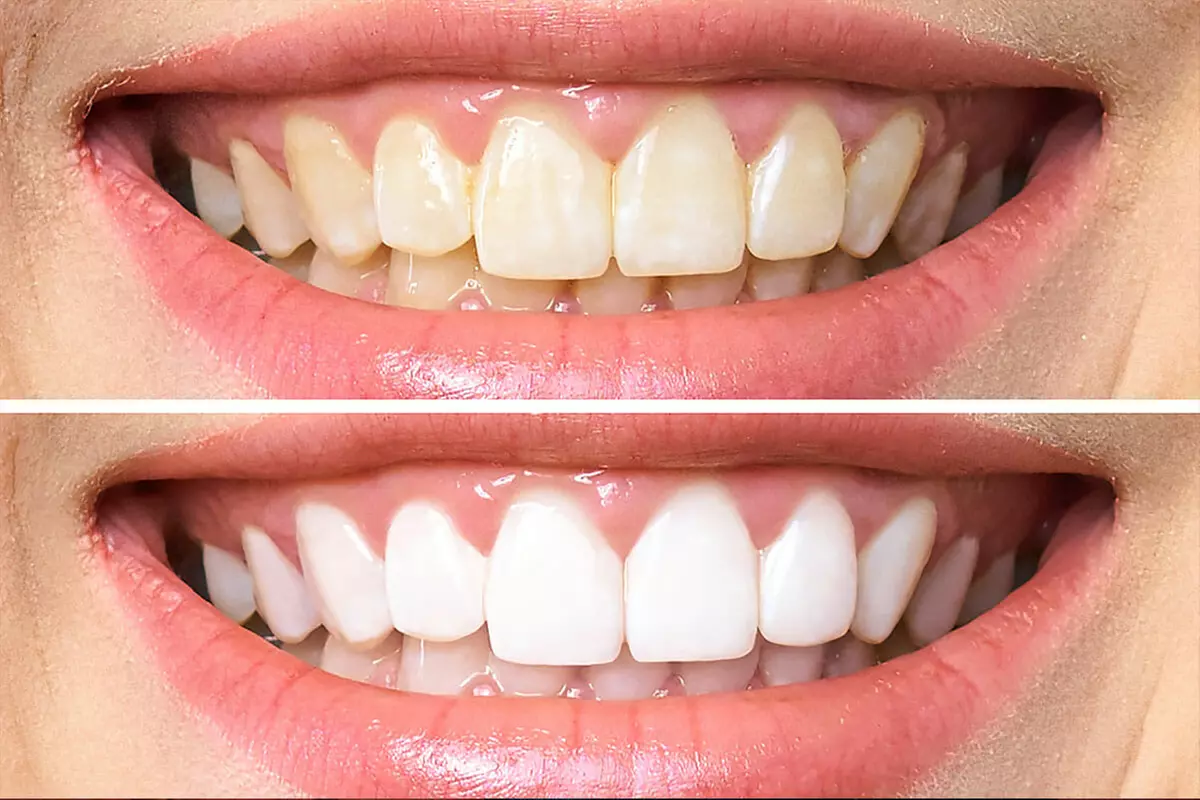 Up to 43% Off on Teeth Whitening at Dental First Care - Primary Image